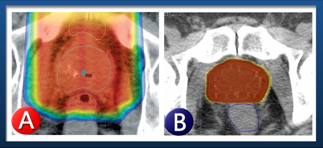 Radiation Effect Chart for Proton Beam & Seed Implant Prostate Cancer Treatment